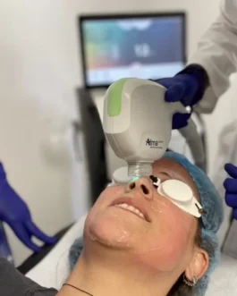 Láser para Rosácea (60m)