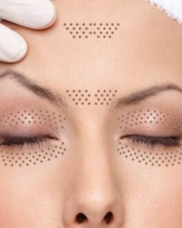 Plasma Pen en Rostro Completo (120 a 180m)